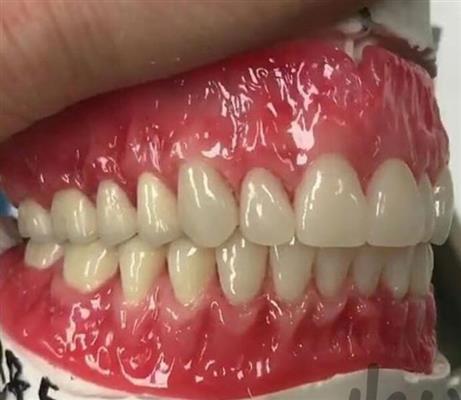 دندان مصنوعی-سمنان-سمنان-دندان پزشکی-بلنگو