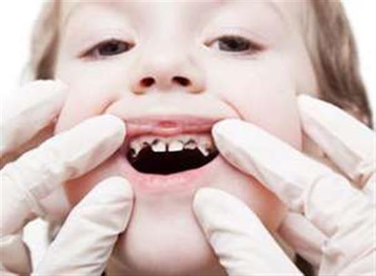 پوسیدگی دندان چیست-تهران-تهران-دندان پزشکی-بلنگو