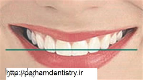 نصب نگین دندان با دوام در پرهام-تهران-تهران-دندان پزشکی-بلنگو