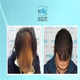 "کاشت مو در ایران نوین تنها با دو و نیم میلیون تومان"