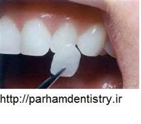 روکش دندان-تهران-تهران-دندان پزشکی-بلنگو