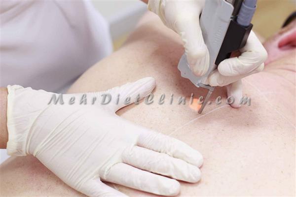 لیزر مو های زائد غرب تهران-تهران-تهران-صنایع-بلنگو